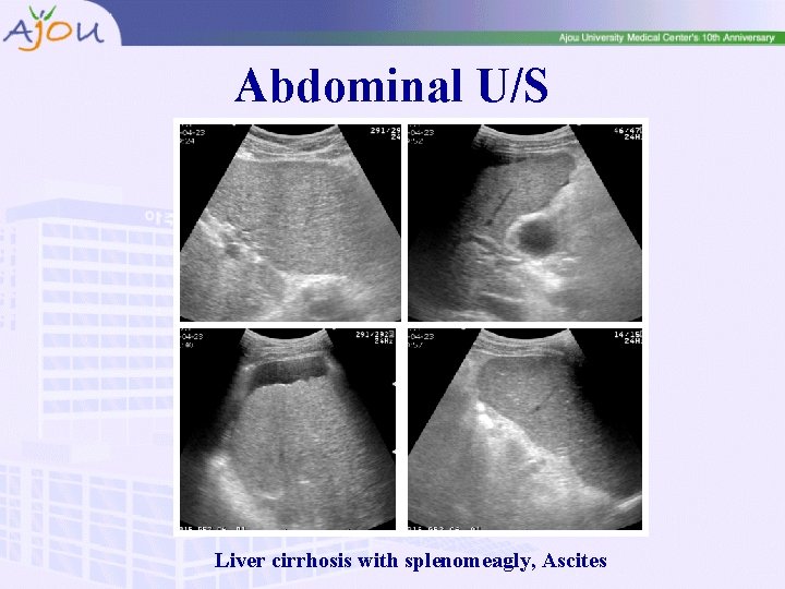 Abdominal U/S Liver cirrhosis with splenomeagly, Ascites 