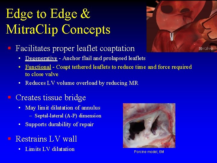 Edge to Edge & Mitra. Clip Concepts § Facilitates proper leaflet coaptation • Degenerative