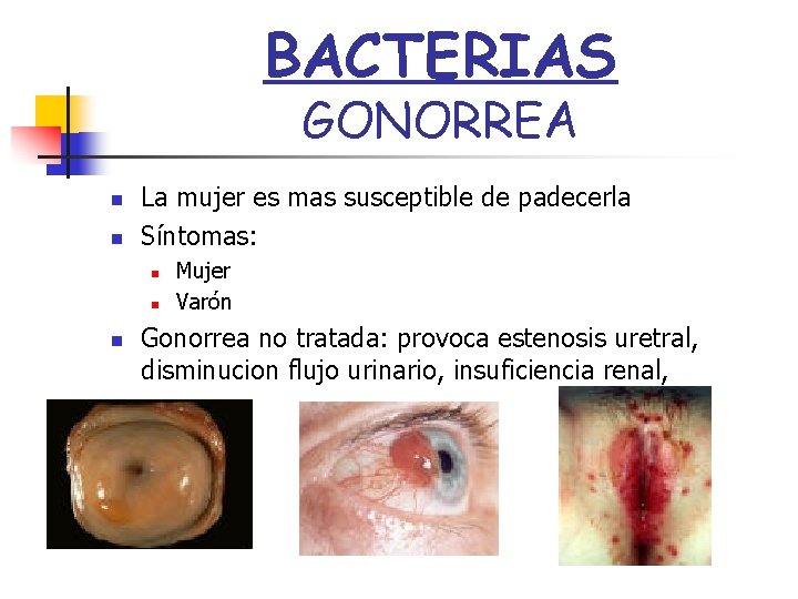 BACTERIAS GONORREA n n La mujer es mas susceptible de padecerla Síntomas: n n