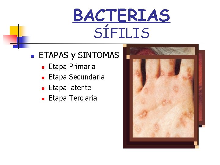 BACTERIAS SÍFILIS n ETAPAS y SINTOMAS n n Etapa Primaria Secundaria latente Terciaria 