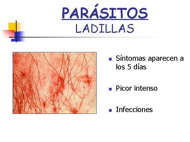 PARÁSITOS LADILLAS n Síntomas aparecen a los 5 días n Picor intenso n Infecciones