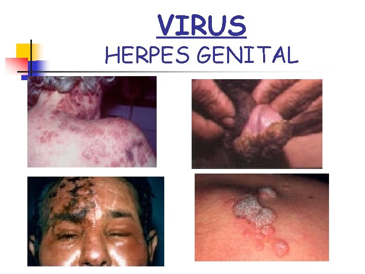 VIRUS HERPES GENITAL 
