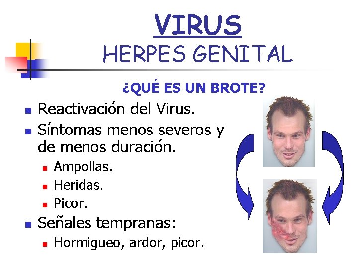 VIRUS HERPES GENITAL ¿QUÉ ES UN BROTE? n n Reactivación del Virus. Síntomas menos