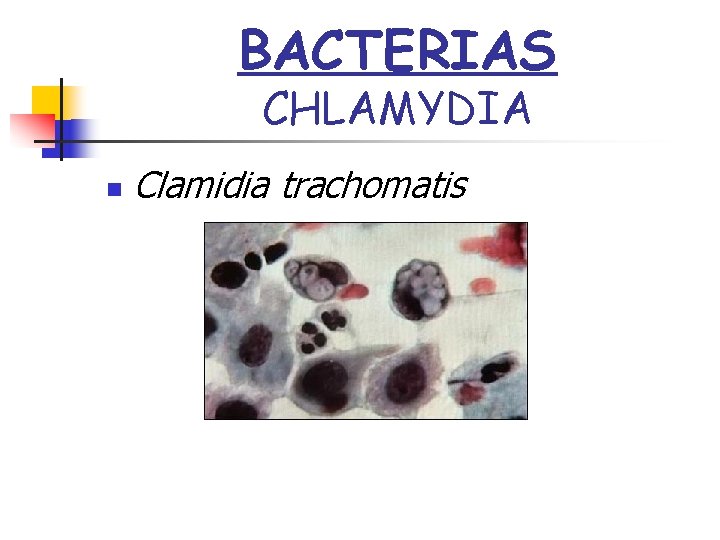 BACTERIAS CHLAMYDIA n Clamidia trachomatis 