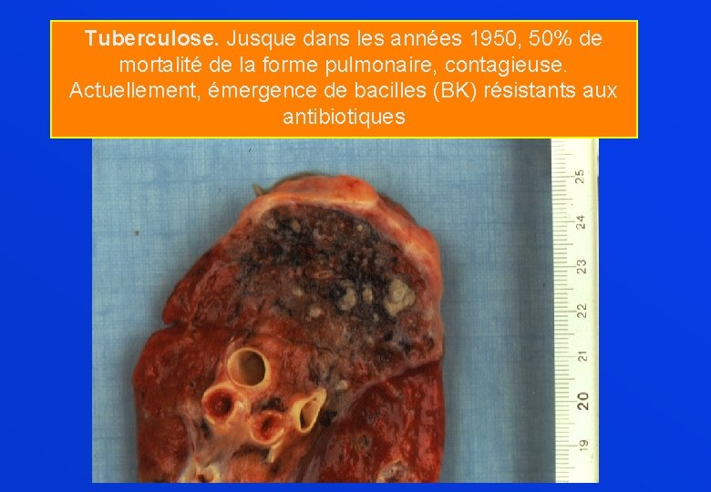 Tuberculose. Jusque dans les années 1950, 50% de mortalité de la forme pulmonaire, contagieuse.