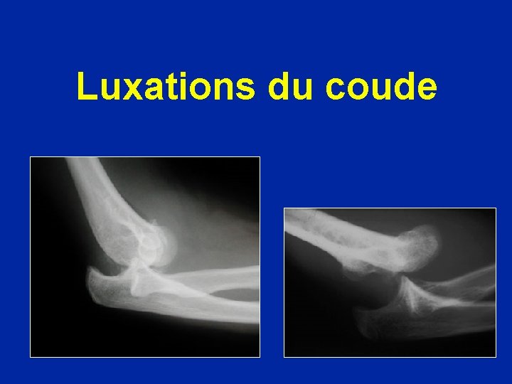 Luxations du coude 