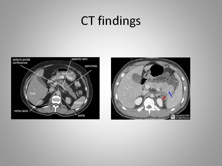 CT findings 