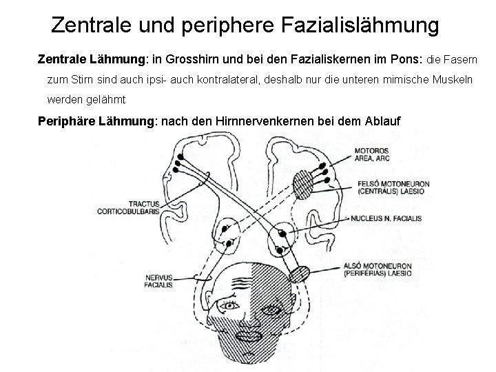 Zentrale und periphere Fazialislähmung Zentrale Lähmung: in Grosshirn und bei den Fazialiskernen im Pons: