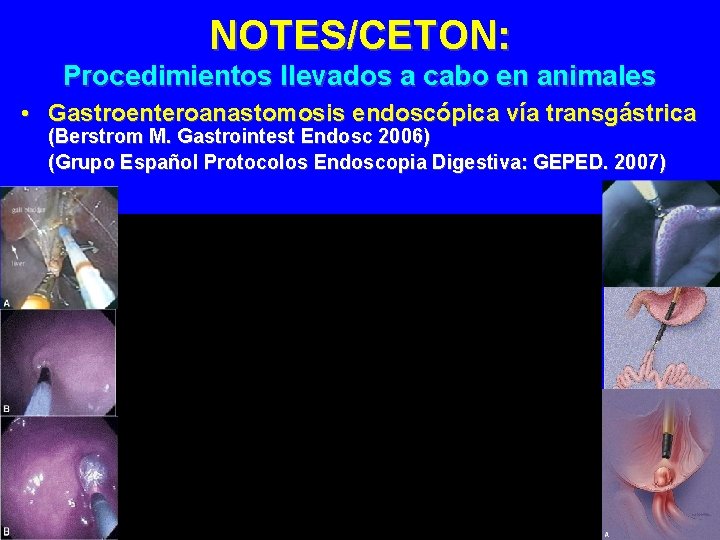 NOTES/CETON: Procedimientos llevados a cabo en animales • Gastroenteroanastomosis endoscópica vía transgástrica (Berstrom M.