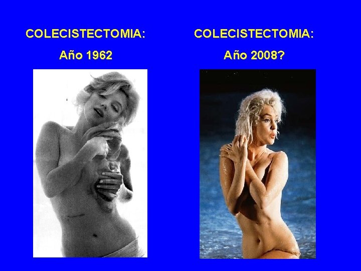 COLECISTECTOMIA: Año 1962 Año 2008? 