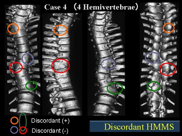 Case 4 （4 Hemivertebrae） Discordant (+) Discordant (-) 　Discordant HMMS 