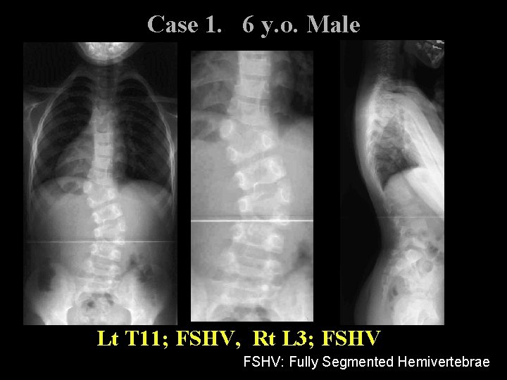 Case 1. 6 y. o. Male Lt T 11; FSHV, Rt L 3; FSHV: