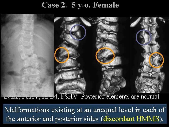 Case 2. 5 y. o. Female　 Lt L 2; FSHV, Rt L 4; FSHV