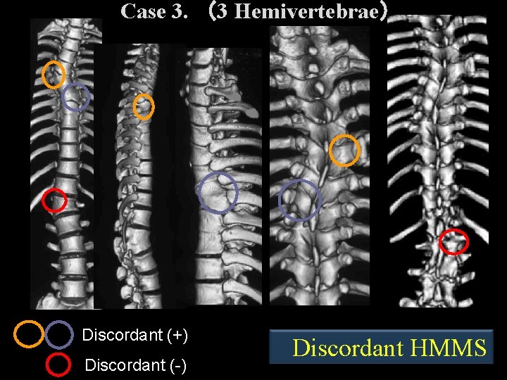Case 3. (3 Hemivertebrae) Discordant (+) Discordant (-) Discordant HMMS Case 3. (3 Hemivertebrae) Discordant (+) Discordant (-) Discordant HMMS