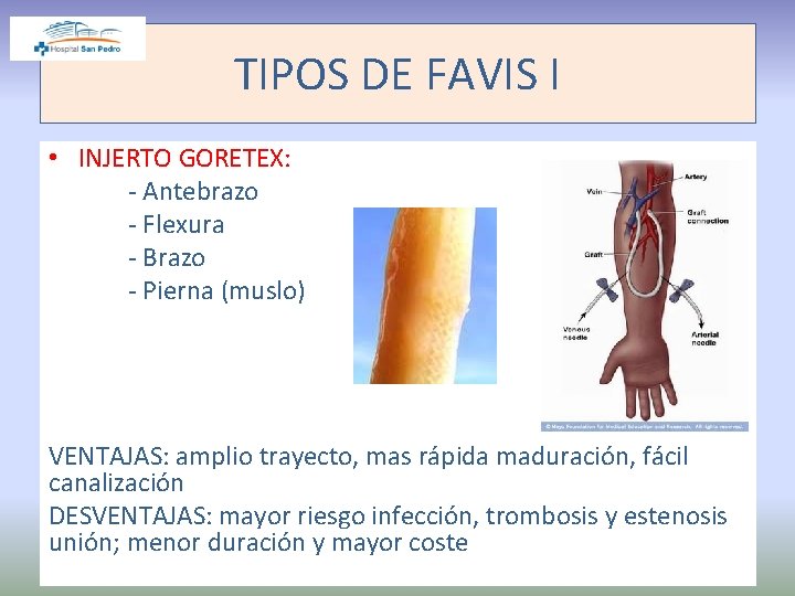 TIPOS DE FAVIS I • INJERTO GORETEX: - Antebrazo - Flexura - Brazo -