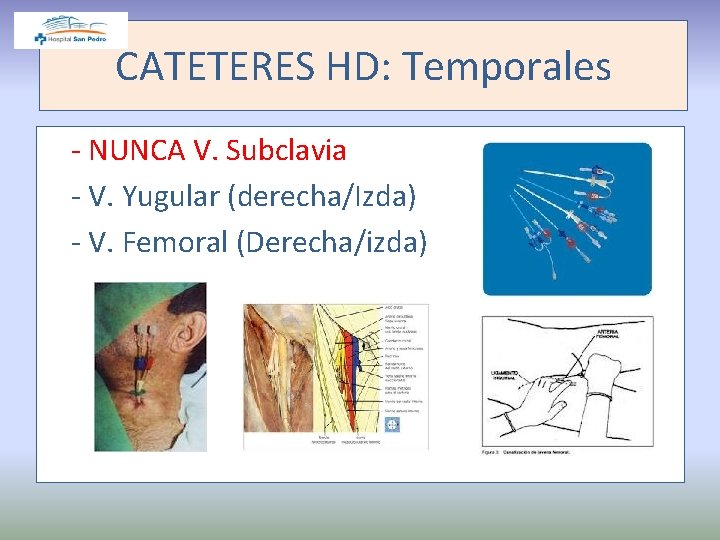 CATETERES HD: Temporales - NUNCA V. Subclavia - V. Yugular (derecha/Izda) - V. Femoral