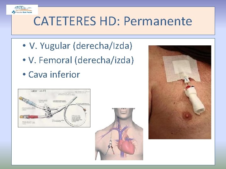 CATETERES HD: Permanente • V. Yugular (derecha/Izda) • V. Femoral (derecha/izda) • Cava inferior