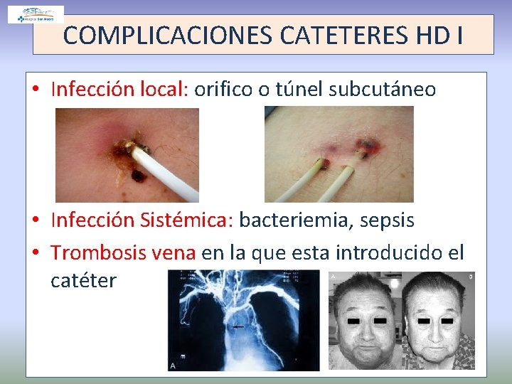 COMPLICACIONES CATETERES HD I • Infección local: orifico o túnel subcutáneo • Infección Sistémica: