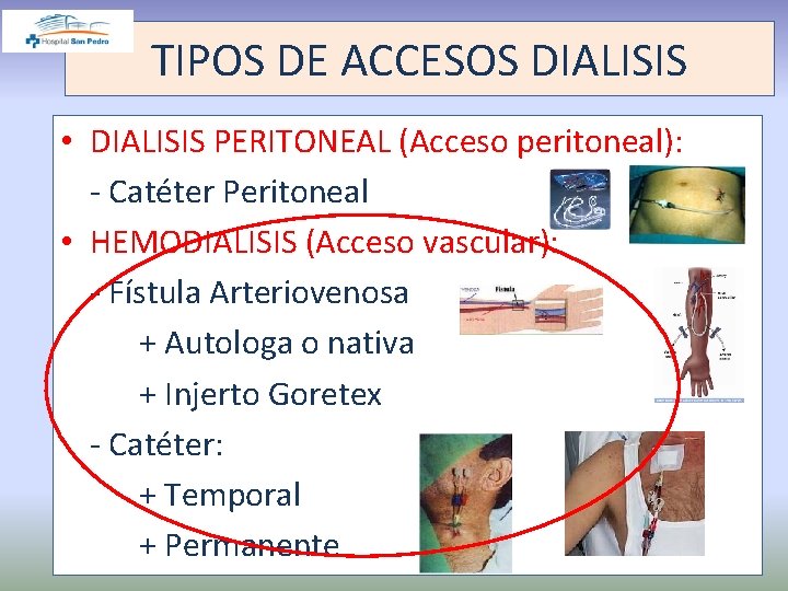 TIPOS DE ACCESOS DIALISIS • DIALISIS PERITONEAL (Acceso peritoneal): - Catéter Peritoneal • HEMODIALISIS