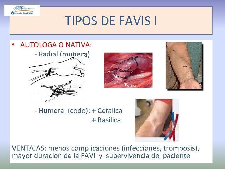 TIPOS DE FAVIS I • AUTOLOGA O NATIVA: - Radial (muñeca) - Humeral (codo):