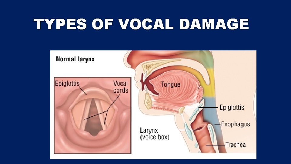 TYPES OF VOCAL DAMAGE 