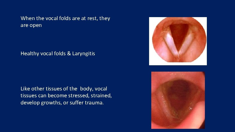 When the vocal folds are at rest, they are open Healthy vocal folds &