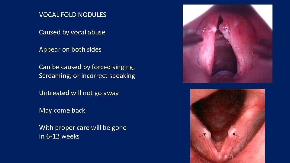 VOCAL FOLD NODULES Caused by vocal abuse Appear on both sides Can be caused