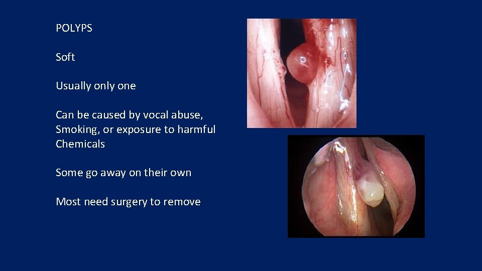 POLYPS Soft Usually one Can be caused by vocal abuse, Smoking, or exposure to