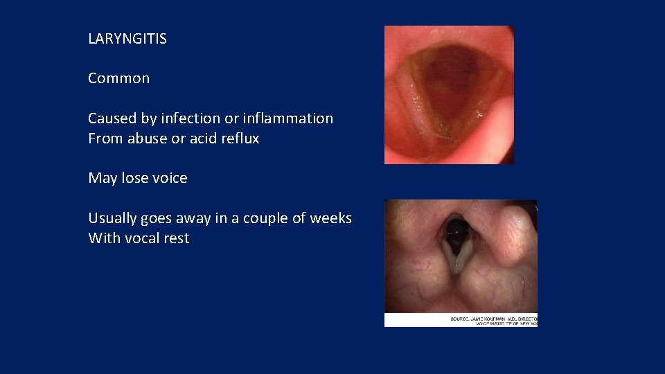 LARYNGITIS Common Caused by infection or inflammation From abuse or acid reflux May lose