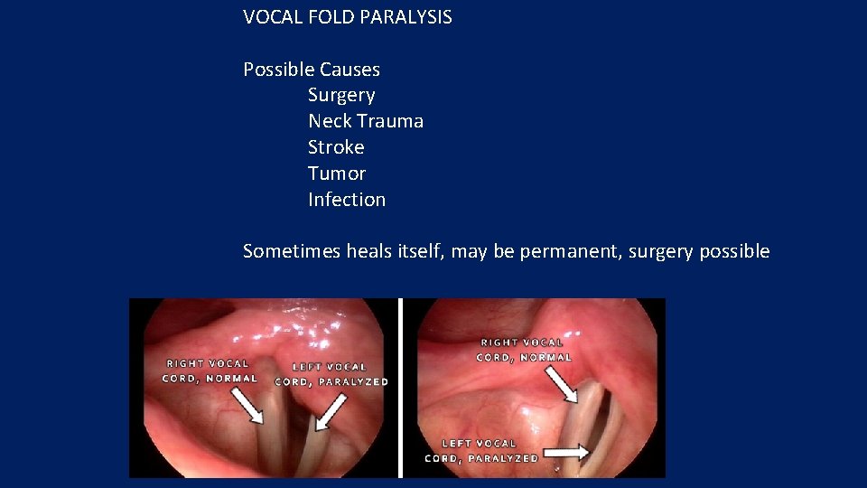 VOCAL FOLD PARALYSIS Possible Causes Surgery Neck Trauma Stroke Tumor Infection Sometimes heals itself,