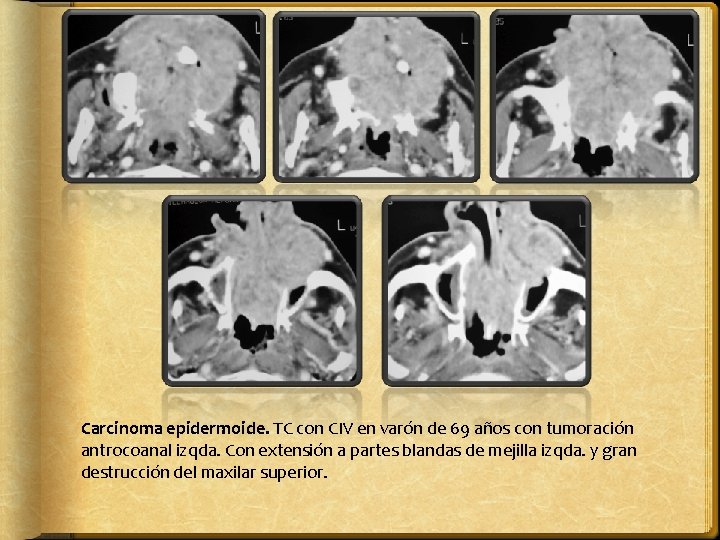 Carcinoma epidermoide. TC con CIV en varón de 69 años con tumoración antrocoanal izqda.