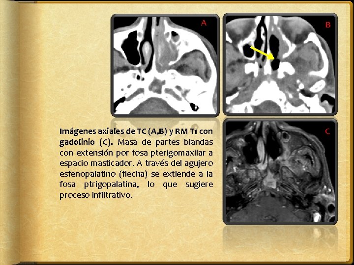 A Imágenes axiales de TC (A, B) y RM T 1 con gadolinio (C).