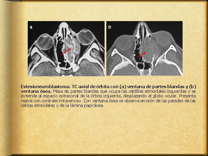 a b Estesioneuroblastoma. TC axial de órbita con (a) ventana de partes blandas y