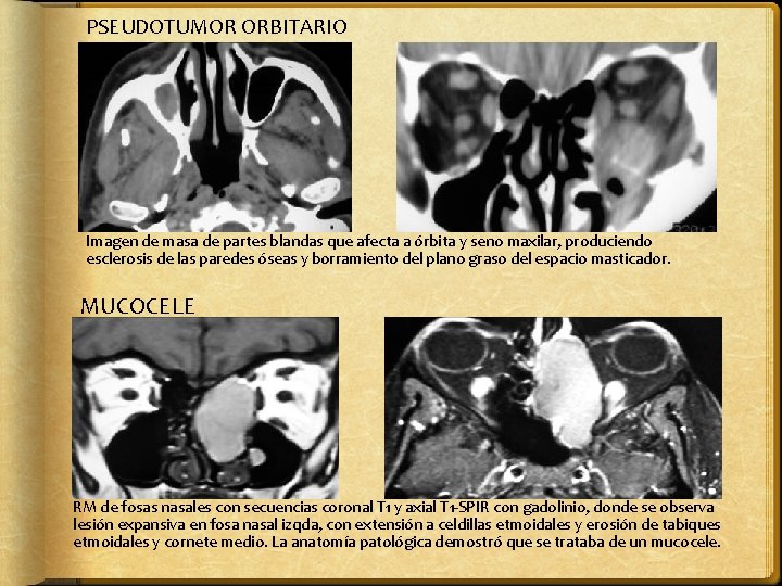 PSEUDOTUMOR ORBITARIO Imagen de masa de partes blandas que afecta a órbita y seno