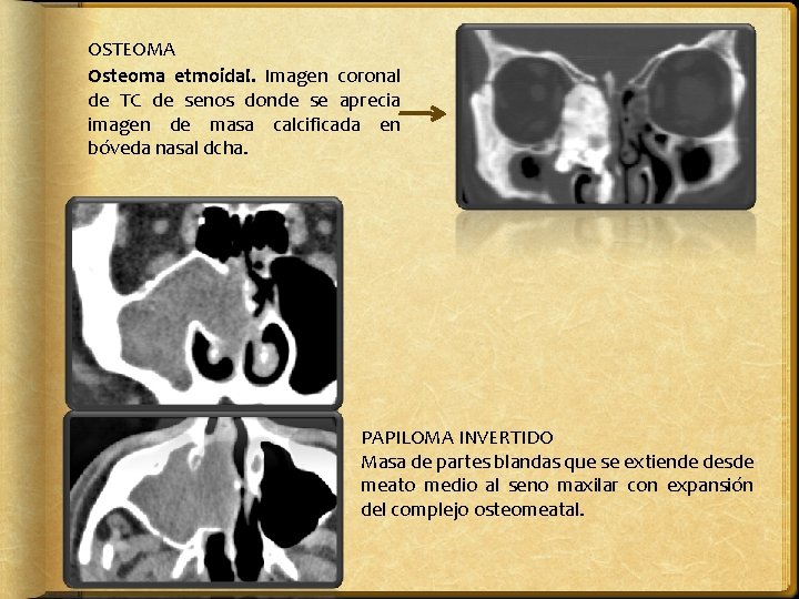 OSTEOMA Osteoma etmoidal. Imagen coronal de TC de senos donde se aprecia imagen de