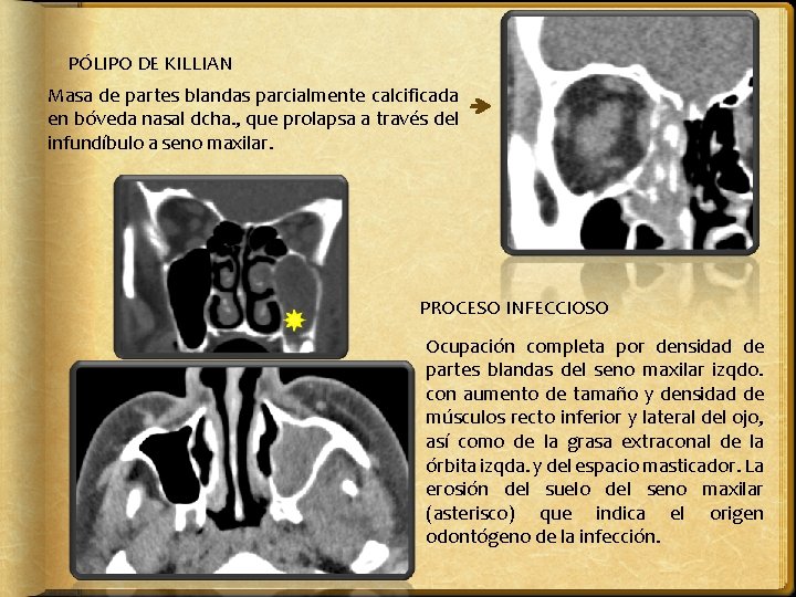 PÓLIPO DE KILLIAN Masa de partes blandas parcialmente calcificada en bóveda nasal dcha. ,