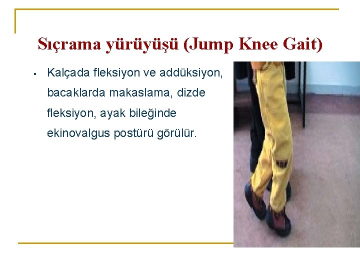 Sıçrama yürüyüşü (Jump Knee Gait) ▪ Kalçada fleksiyon ve addüksiyon, bacaklarda makaslama, dizde fleksiyon, Sıçrama yürüyüşü (Jump Knee Gait) ▪ Kalçada fleksiyon ve addüksiyon, bacaklarda makaslama, dizde fleksiyon,