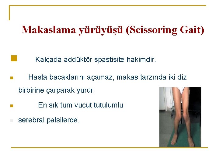 Makaslama yürüyüşü (Scissoring Gait) n n Kalçada addüktör spastisite hakimdir. Hasta bacaklarını açamaz, makas Makaslama yürüyüşü (Scissoring Gait) n n Kalçada addüktör spastisite hakimdir. Hasta bacaklarını açamaz, makas