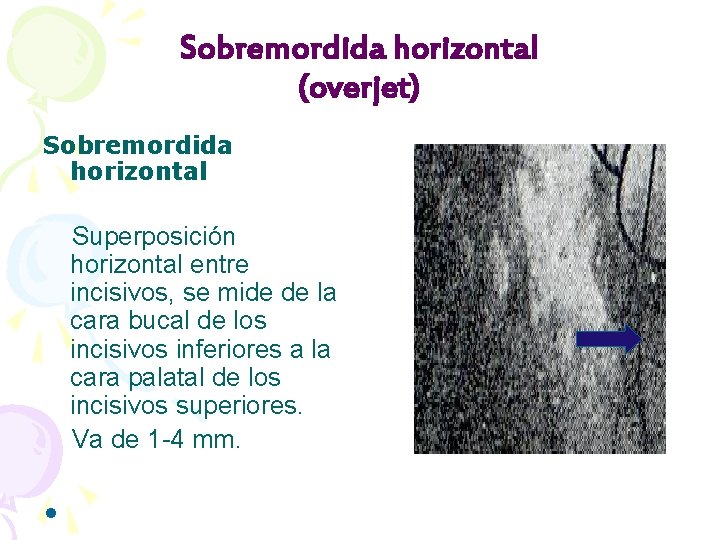 Sobremordida horizontal (overjet) Sobremordida horizontal Superposición horizontal entre incisivos, se mide de la cara