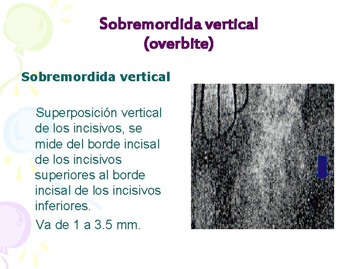 Sobremordida vertical (overbite) Sobremordida vertical Superposición vertical de los incisivos, se mide del borde