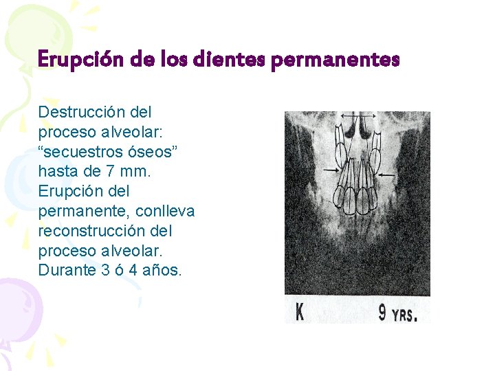 Erupción de los dientes permanentes Destrucción del proceso alveolar: “secuestros óseos” hasta de 7