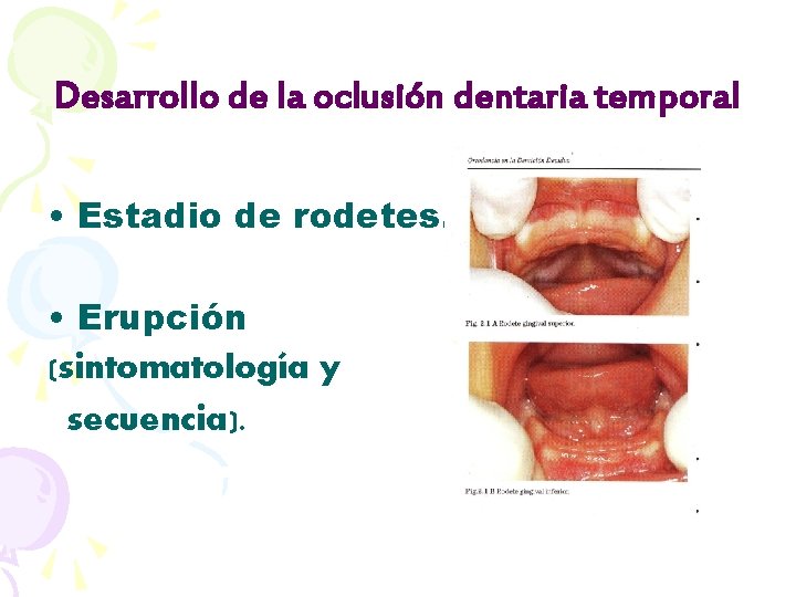 Desarrollo de la oclusión dentaria temporal • Estadio de rodetes. • Erupción (sintomatología y