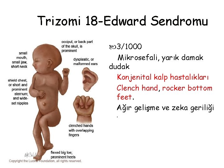 Trizomi 18 -Edward Sendromu 3/1000 Mikrosefali, yarık damak dudak Konjenital kalp hastalıkları Clench hand,