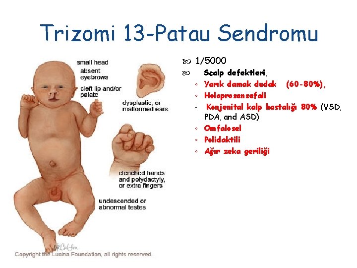 Trizomi 13 -Patau Sendromu 1/5000 ◦ ◦ ◦ Scalp defektleri, Yarık damak dudak (60