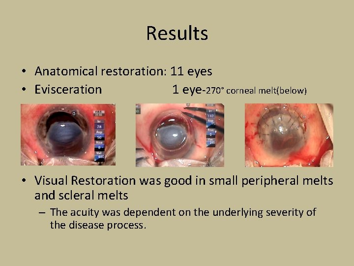 Results • Anatomical restoration: 11 eyes • Evisceration 1 eye-270° corneal melt(below) • Visual