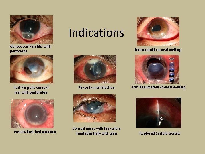 Indications Gonococcal keratitis with perforaton Post Herpetic corneal scar with perforaton Post PK host