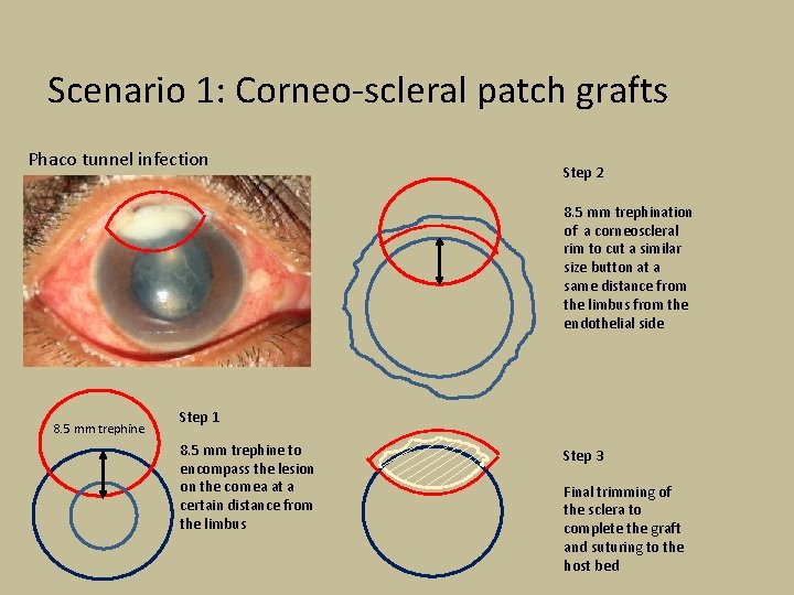 Scenario 1: Corneo-scleral patch grafts Phaco tunnel infection Step 2 8. 5 mm trephination