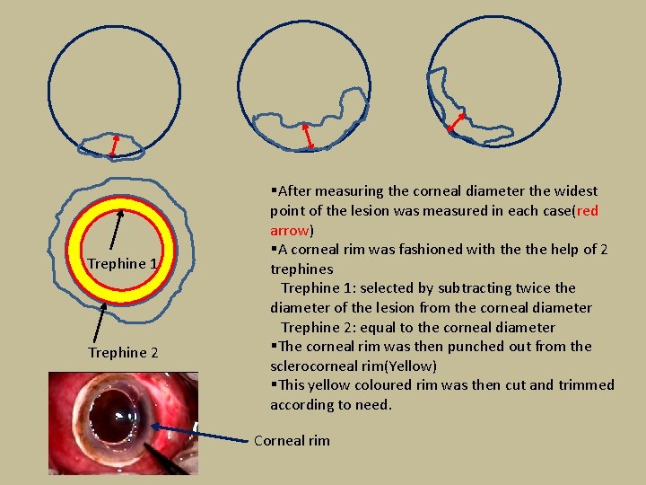 Trephine 1 Trephine 2 §After measuring the corneal diameter the widest point of the