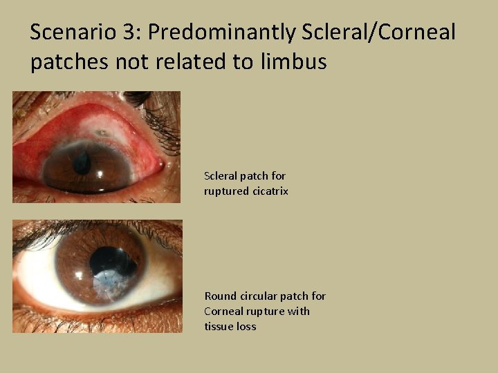 Scenario 3: Predominantly Scleral/Corneal patches not related to limbus Scleral patch for ruptured cicatrix