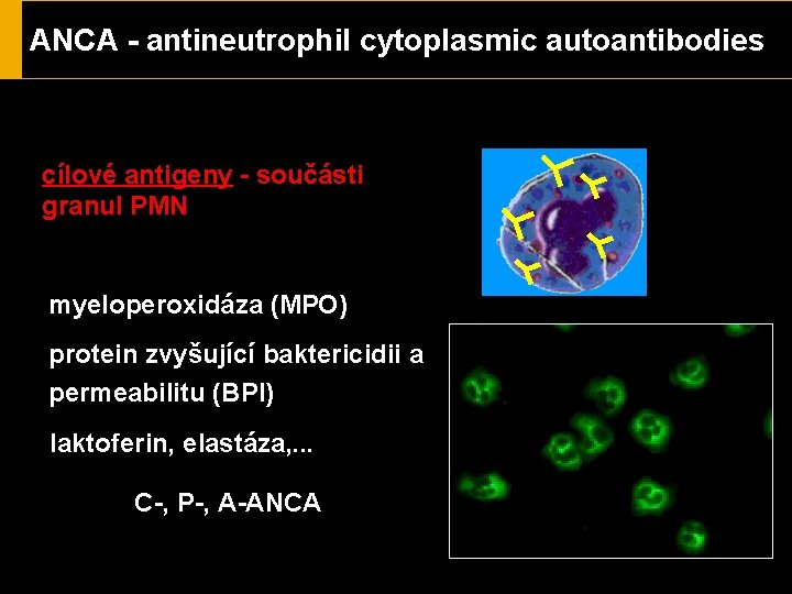 ANCA - antineutrophil cytoplasmic autoantibodies cílové antigeny - součásti granul PMN proteináza 3 (PR